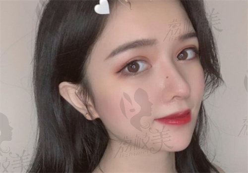 上海美莱黄惠真医生隆鼻
