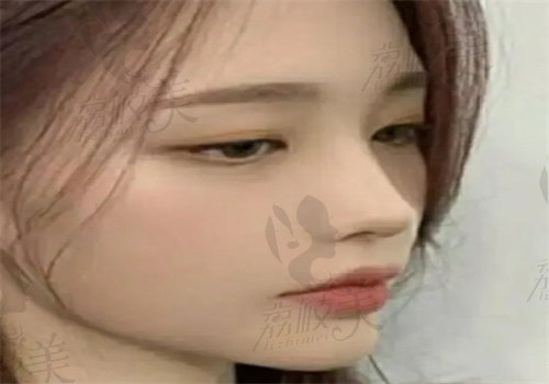 上海美莱黄惠真医生隆鼻