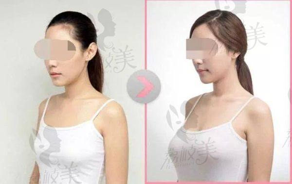 唐新輝醫(yī)生做隆胸好嗎
