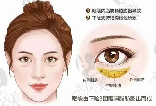 廣州美詩(shī)沁不開(kāi)刀去眼袋價(jià)格