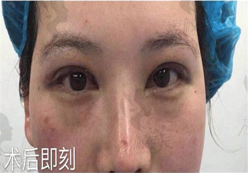 吕方中医生双眼皮技术好