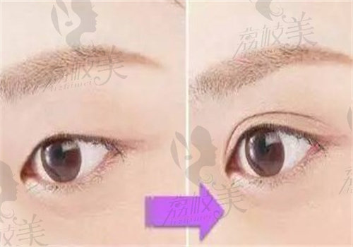 为什么选择周瑜医生修复双眼皮