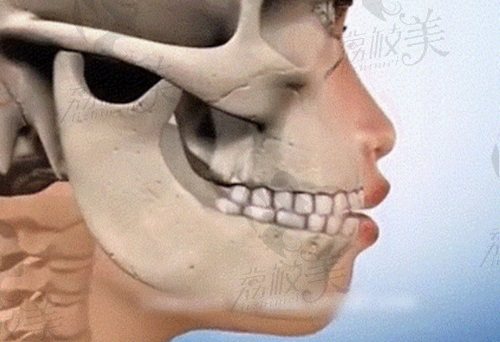 华 西口腔医院李继华正颌怎么样？