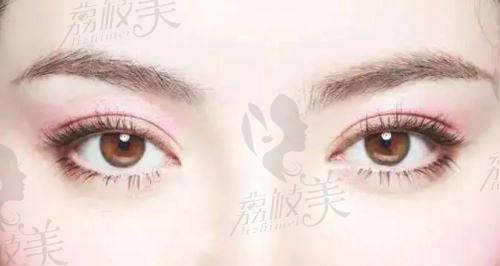 石家庄美联臣做双眼皮多少钱