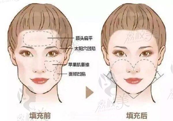 洛阳哪个医院打玻尿酸正规