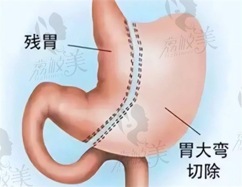 四川现代医院刘亚平做袖状胃旷肠减重