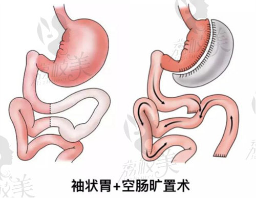 四川现代医院刘亚平做袖状胃旷肠减重