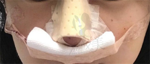 广州崔东做鼻修复怎么样