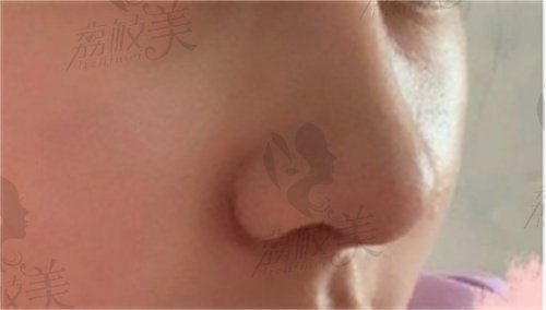 广州崔东做鼻修复怎么样