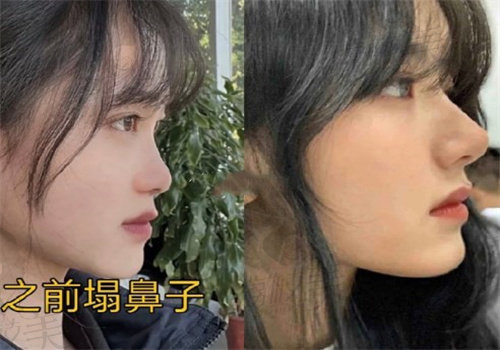 广州崔东医生鼻修复技术