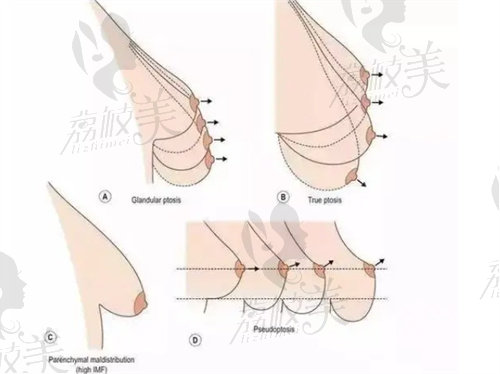 花苞提升手术和双环悬吊提升手术的区别