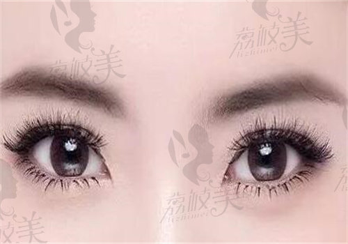 常冬青双眼皮修复怎么样