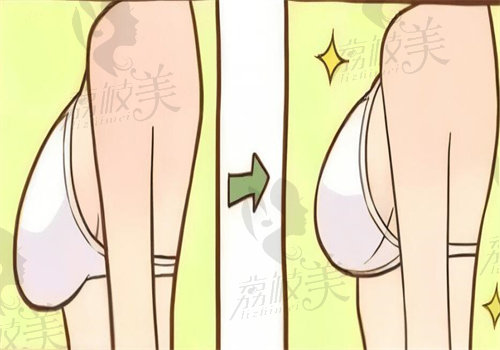 深圳艺星隆胸术后管理好