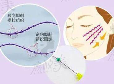 韩国埋线提升做的好的医生前三推荐