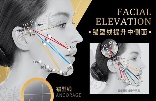 成都刘远程筋膜提升的价位