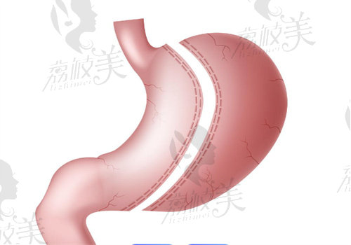 四川現(xiàn)代醫(yī)院劉亞平做胃轉(zhuǎn)流支架手術(shù)多少錢