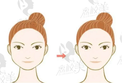 哈尔滨杨宇梓做面部吸脂怎么样