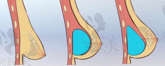 北京画美整形隆胸怎么样