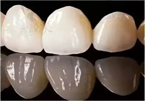 攀枝花明皓口腔周虎跃做拉瓦全瓷牙具体实例
