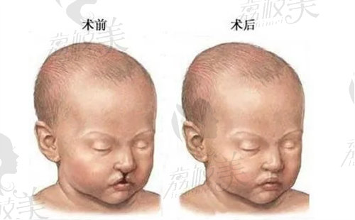 四川现代医院李虎唇腭裂修复怎么样