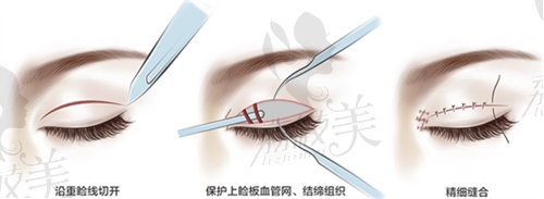 上海海华李营医生做双眼皮手术