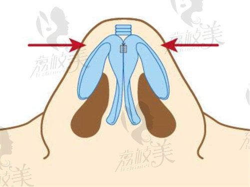 北京安陽(yáng)醫(yī)生鼻子實(shí)例