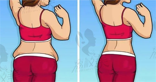 成都新丽美陈再洪做腹壁成形
