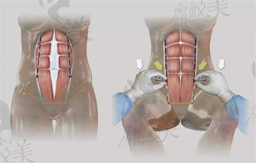 成都新丽美陈再洪做腹壁成形