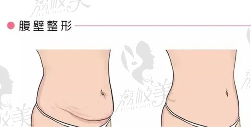 成都新丽美陈再洪做腹壁成形