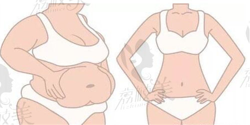 成都新丽美陈再洪做腹壁成形