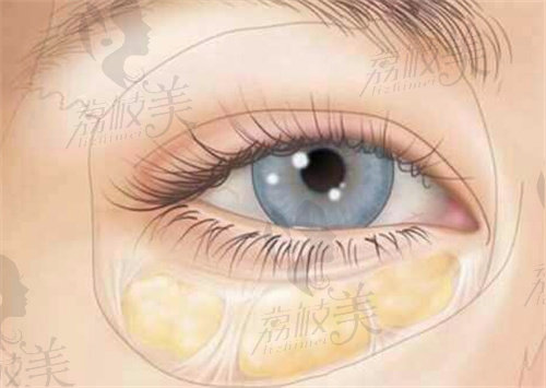张冰洁眼袋修复手术
