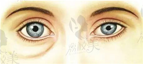 张冰洁眼袋修复手术