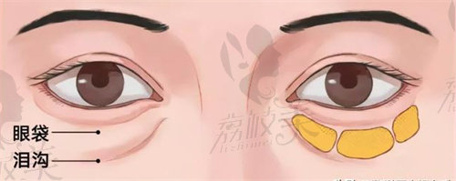 张冰洁眼袋修复手术