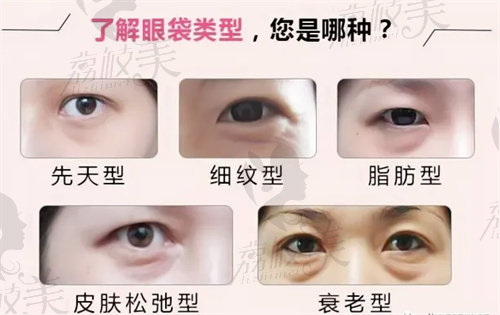 张冰洁眼袋修复手术