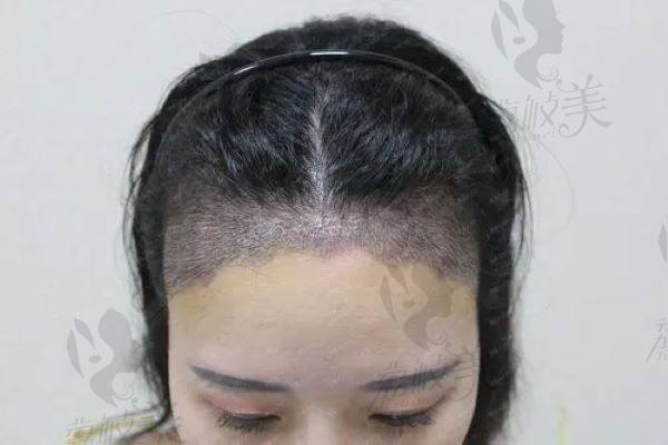 重庆医 科 大学附属医院整形美容科植发实例分析