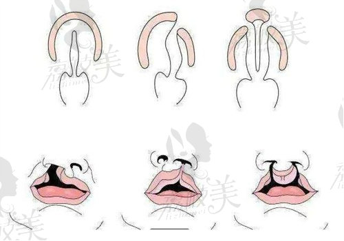 四川現(xiàn)代李虎做完全性腭裂（單側(cè)）技術(shù)特點(diǎn)