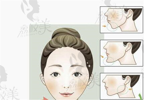 四川现代李献和做双颌手术口碑怎么样