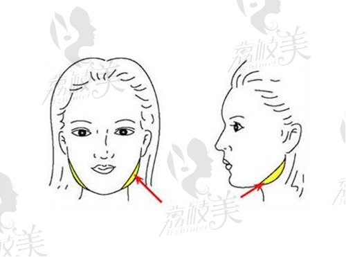 重庆华美邓诚下颌角磨骨