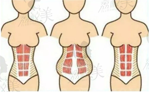廣州新市醫(yī)院王擎做腹壁成形