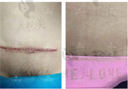 上海江城皮肤医院治疗疤痕手术实例