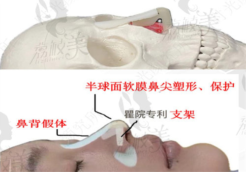 瞿健醫(yī)生做鼻子好不好