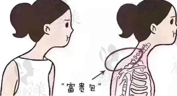 國內(nèi)富貴包手術(shù)哪個醫(yī)院較好