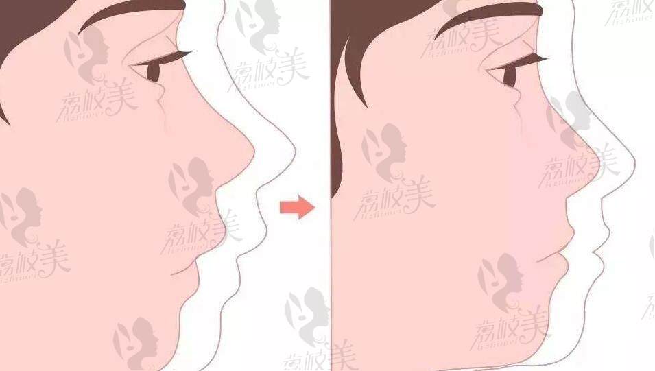 西安正颌手术费用一般是多少钱
