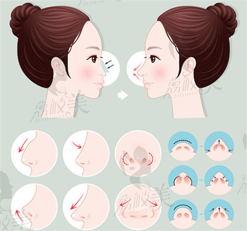 上海美莱游远榕做鼻子要多少钱