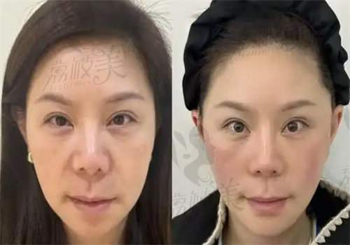 王乙立面部提升怎么样