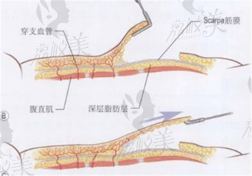 夏学颖做腹壁手术怎样