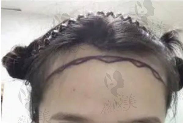 宁波亚植植发收费透明，无隐性消费