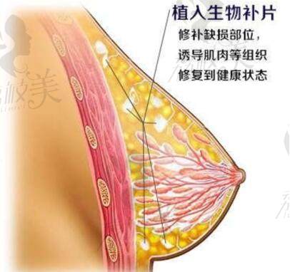 美波婷胶原丰胸价格是多少钱