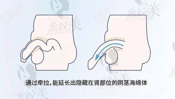國內做高端微創(chuàng)延長術的醫(yī)院