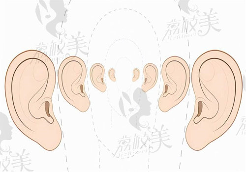 小耳畸形国内补助条件有哪些
